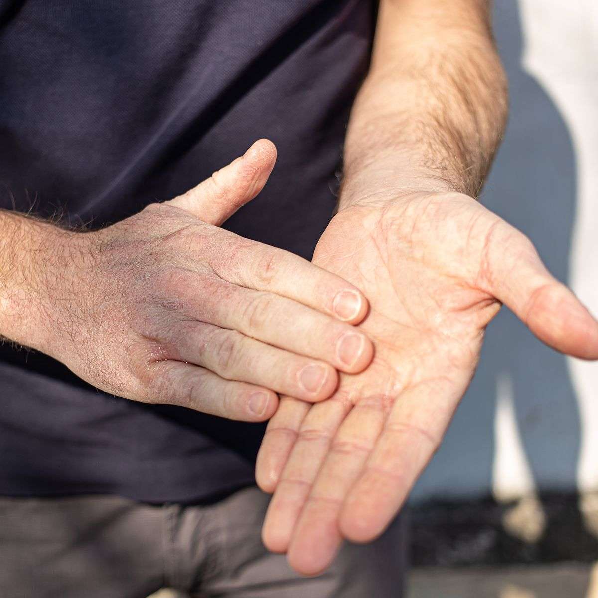 Child's cracked hands damaged from excessive use of 70% alcohol sanitizer illustrating destroying your skin